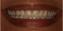after smile
